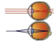 低视力眼球